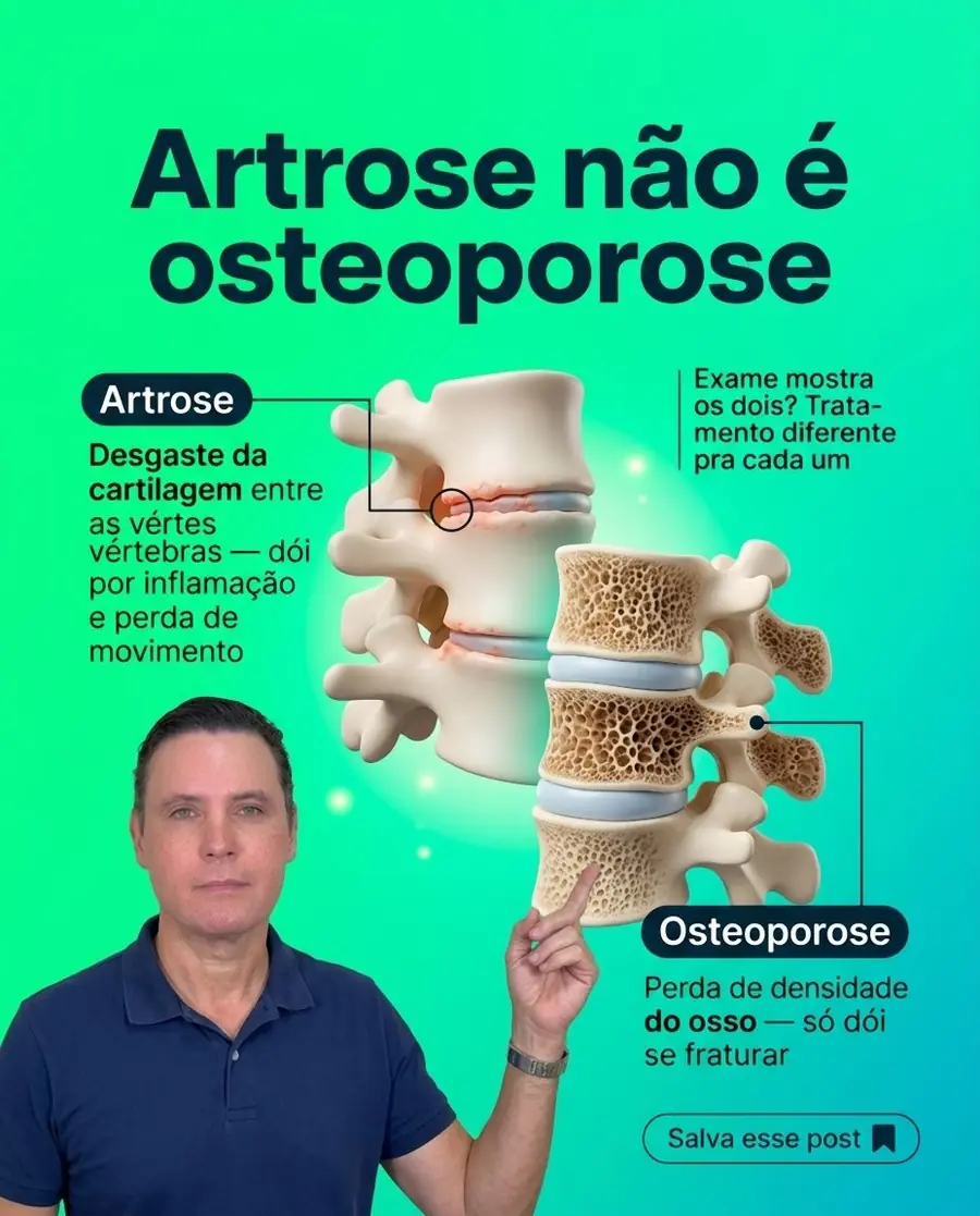 Post do Dr. Hélio no Instagram: Artrose não é osteoporose