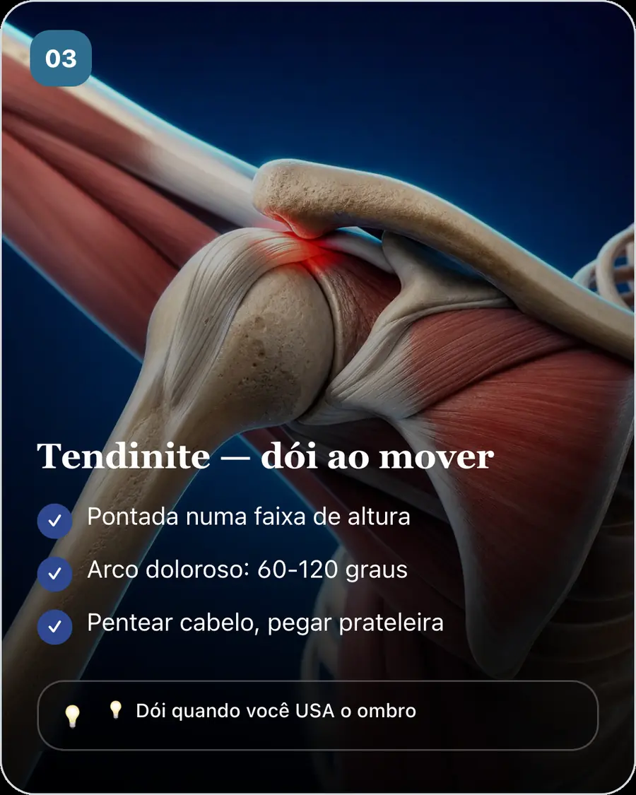 Tendinite — dói ao mover. Pontada numa faixa de altura. Arco doloroso: 60-120 graus. Pentear cabelo, pegar prateleira