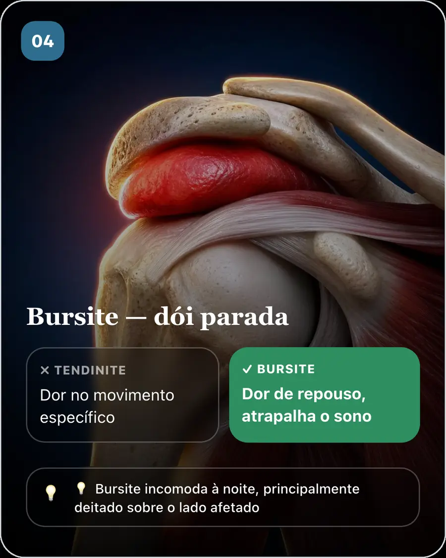 Bursite — dói parada