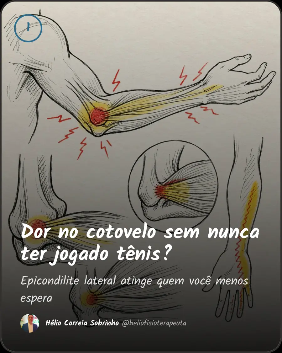 Dor no cotovelo sem nunca ter jogado tênis?. Epicondilite lateral atinge quem você menos espera