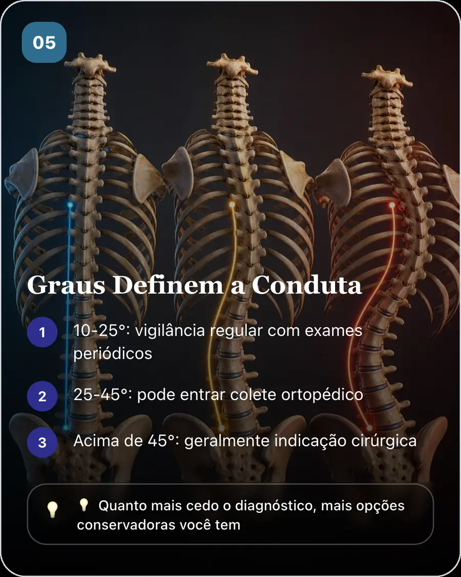 Graus Definem a Conduta. 10-25°: vigilância regular com exames periódicos. 25-45°: pode entrar colete ortopédico. Acima de 45°: geralmente indicação cirúrgica
