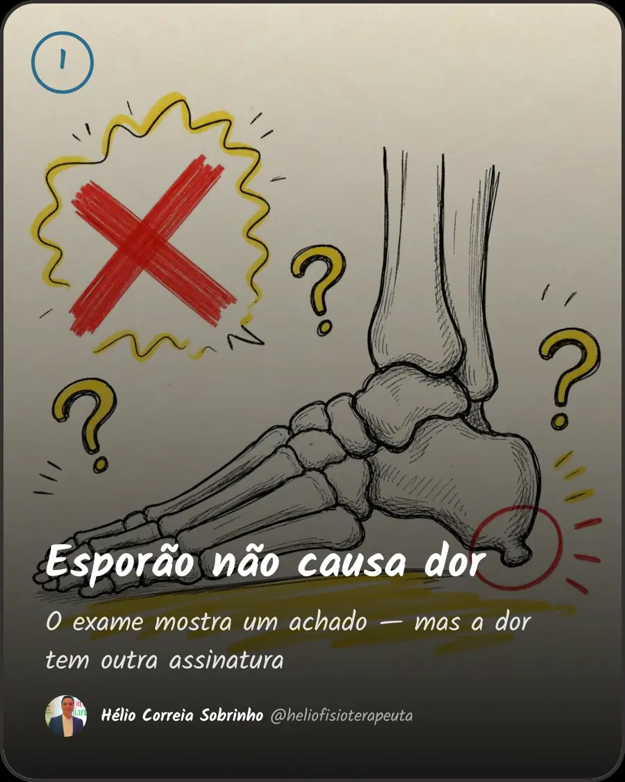 Esporão não causa dor. O exame mostra um achado — mas a dor tem outra assinatura