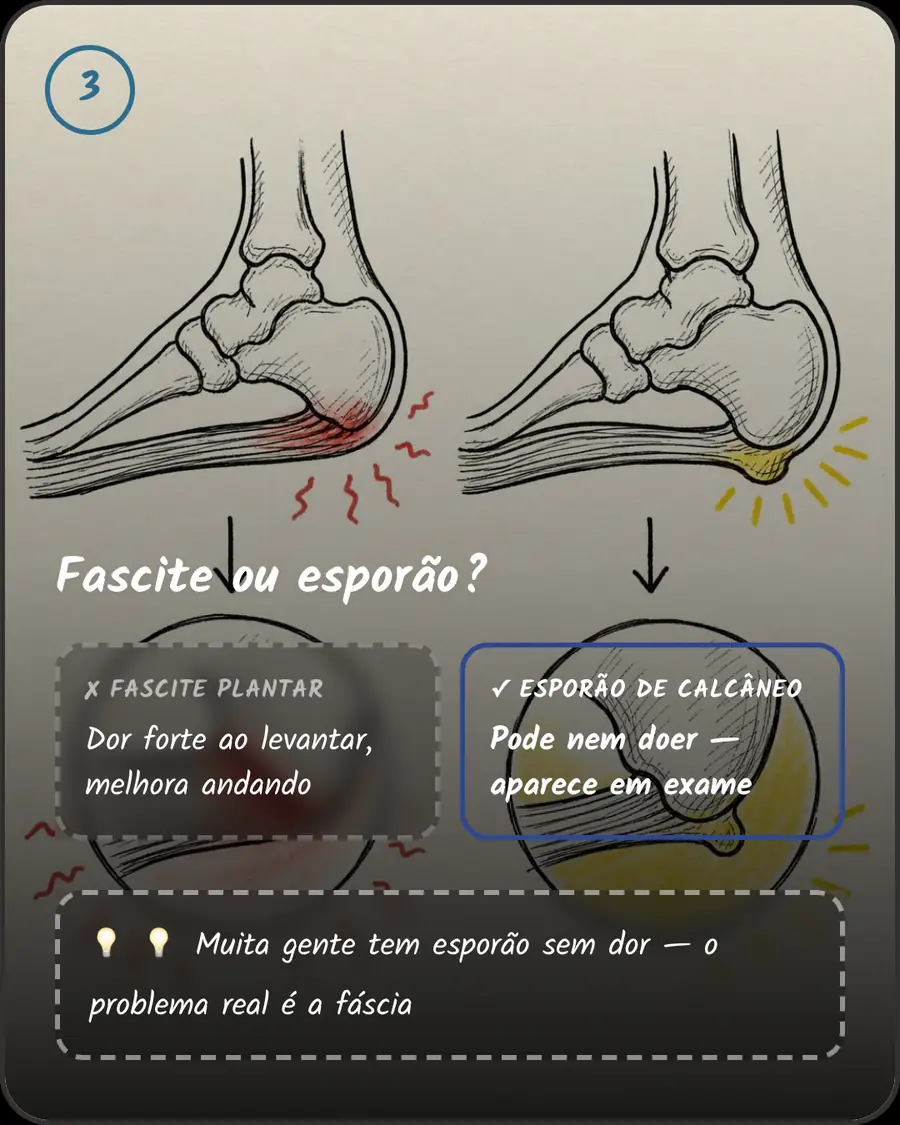 Fascite ou esporão?